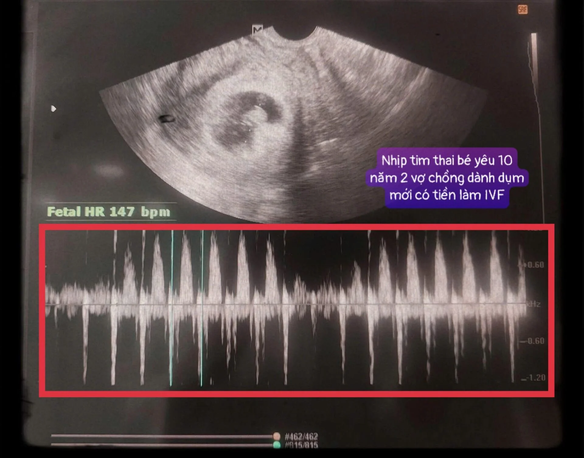 10 Năm Dành Dụm Tiền Làm IVF, Để Chờ Đợi Một Lần Nghe Nhịp Tim Thai Con Mình!