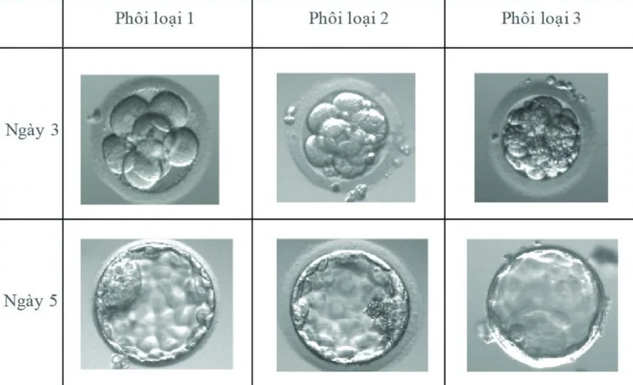 Chất lượng phôi có ảnh hưởng đến tỷ lệ thành công khi làm IVF - Nguồn ảnh: IVF Mỹ Đức