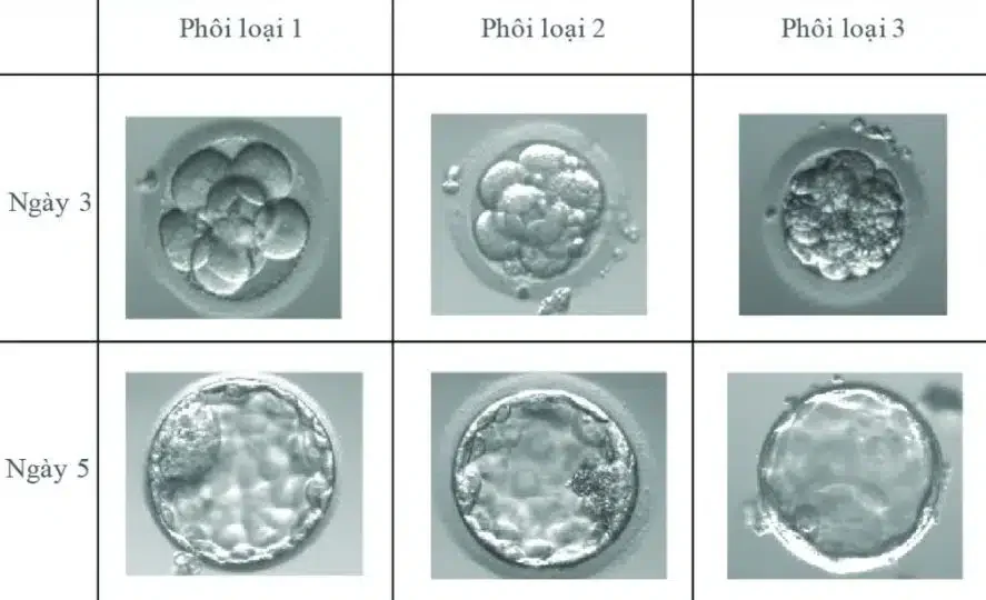 Chất lượng phôi là một trong những nguyên nhân thất bại khi làm IVF - Nguồn ảnh: IVF Mỹ Đức