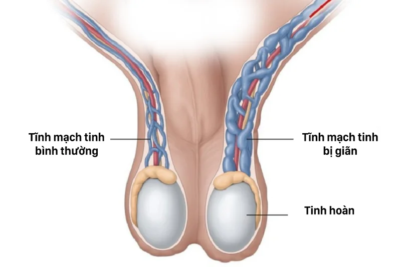 Giãn tĩnh mạch thừng tinh là nguyên nhân tiềm ẩn khiến cho nam giới bị hiếm muộn - Nguồn ảnh: Internet
