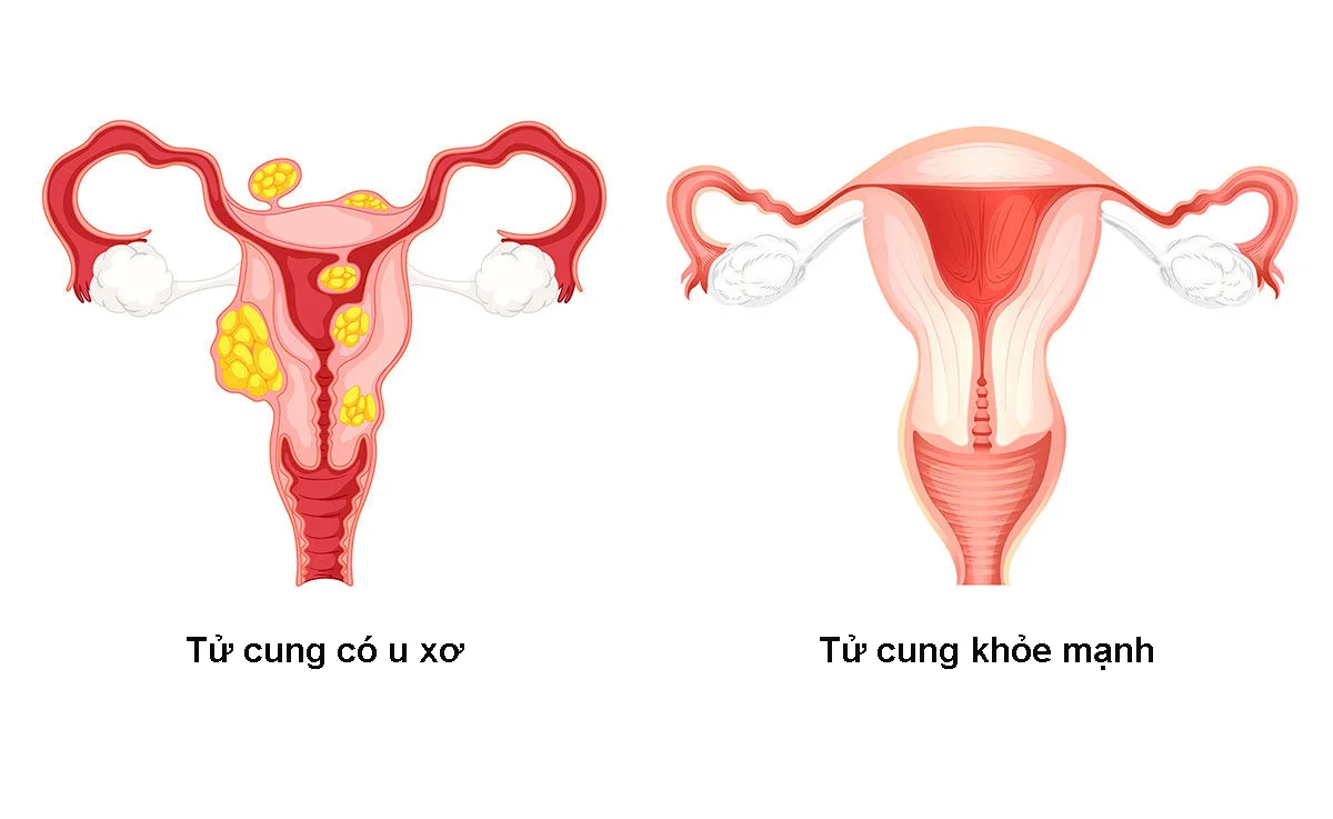 U xơ tử cung, lạc nội mạc tử cung có thể cản trở quá trình thụ thai tự nhiên, ảnh hưởng đến chất lượng nội mạc và quá trình làm tổ - Nguồn ảnh: Internet