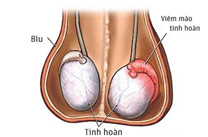 Viêm tinh hoàn có thể là nguyên nhân gây hiếm muộn ở nam giới  - Nguồn ảnh: Internet