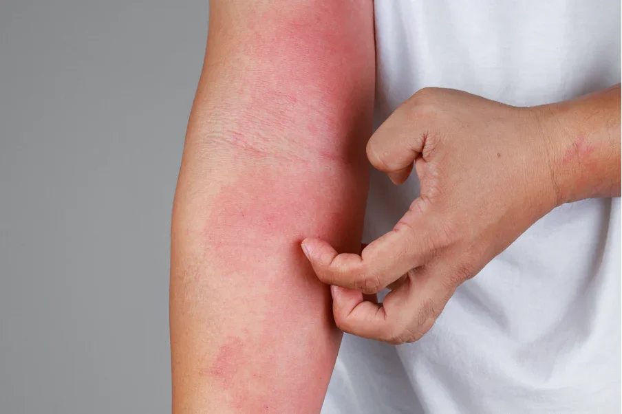 Tình trạng dị ứng có thể xuất hiện nếu sử dụng sản phẩm kém chất lượng 