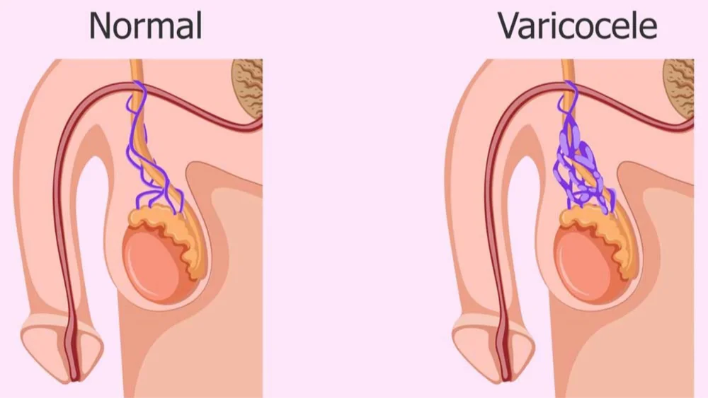 Mức độ bệnh càng cao, nguy cơ ảnh hưởng đến chất lượng tinh trùng càng lớn
