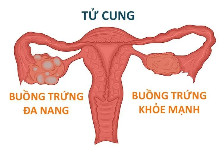 Phụ nữ PCOS có nhiều nang nhỏ không phát triển đầy đủ, dẫn đến AMH cao nhưng chất lượng nang kém. - Nguồn ảnh: Internet