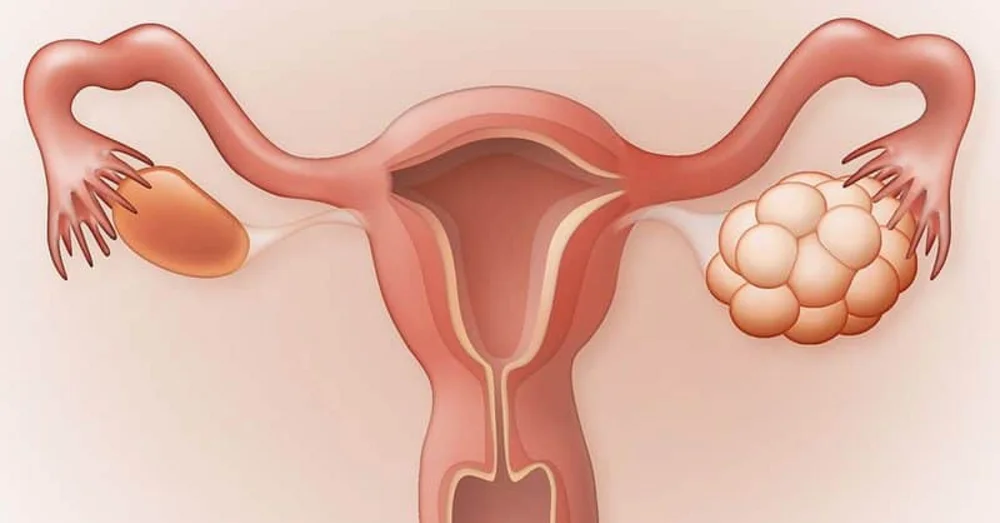 Hội chứng quá kích buồng trứng có thể xảy ra khi làm IVF
