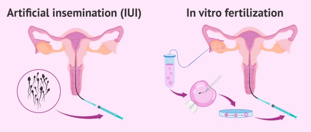 IVF và IUI là hai phương pháp hỗ trợ sinh sản phổ biến 
